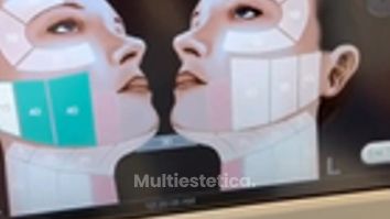Ultherapy Lifting Sin Cirugia -Dr. Alejandro Méndez Sashida