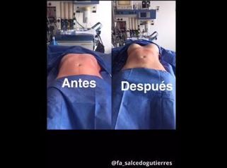 Lipoescultura mas implantes mamarios