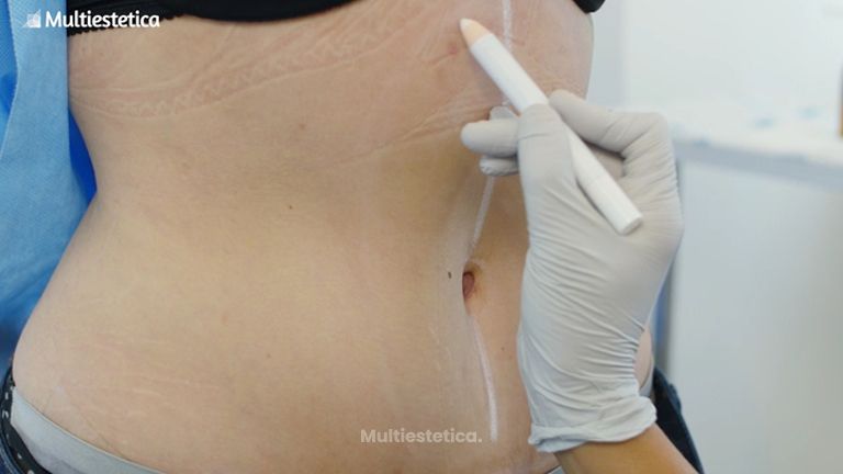 Abdominoplastia