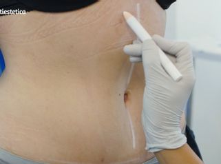 Abdominoplastia