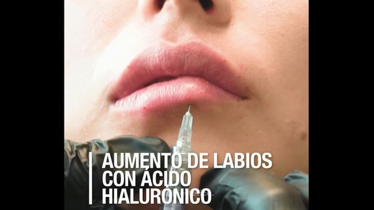 Aumento de labios con Ácido Hialurónico