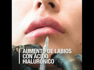 Aumento de labios con Ácido Hialurónico