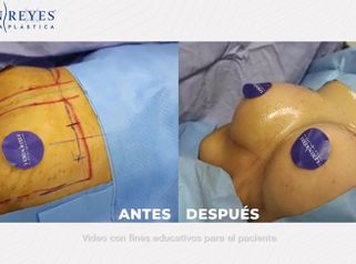 Aumento de busto - Dr. Lenin Alfonso Reyes Ibarra