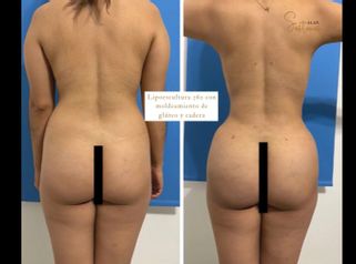 Lipoescultura - Dr. Alan Sóstenes