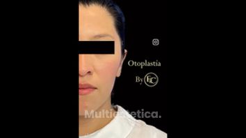 Otoplastia - Dr. Franco Cravioto