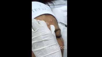 Aplicación de Toxina botulínica