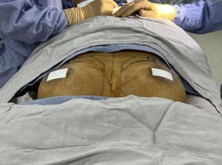 Aumento de busto - Dr. Rigoberto Castellanos