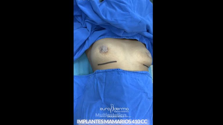 Aumento de busto - Euroderma
