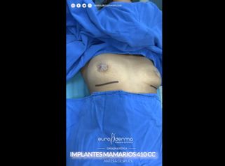 Aumento de busto - Euroderma