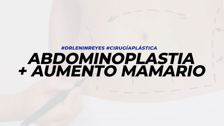 Abdominoplastia + Aumento mamrio - Dr. Lenin Alfonso Reyes Ibarra