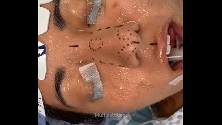 Rinoplastia - Dr. Eduardo Cartagena
