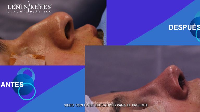 Rinoplastia - Dr. Lenin Alfonso Reyes Ibarra