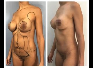 Lipoescultura - Dr. Christian Augusto Morales Orozco