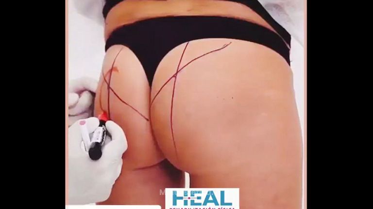 Relleno de glúteos con Ácido Hialurónico - Clínica Heal Aesthetics