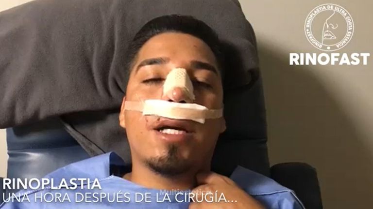 Testimonio rinoplastia