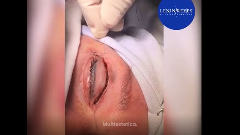Blefaroplastia