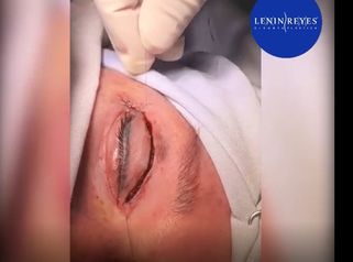 Blefaroplastia