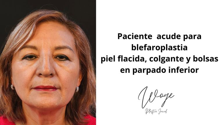 Blefaroplastia - Dr. Carlos Woge