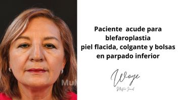 Blefaroplastia - Dr. Carlos Woge