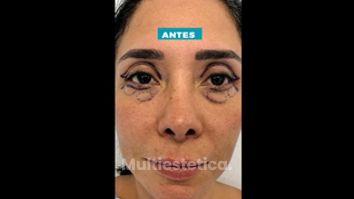 Blefaroplastia - Dr. Jhony Camarero