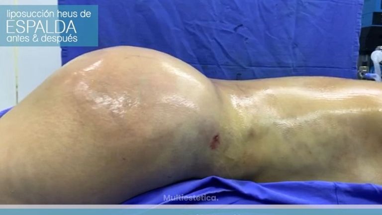 Gluteoplastia - Euroderma