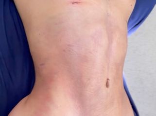 Lipoescultura - Dra. Rosy Mercado