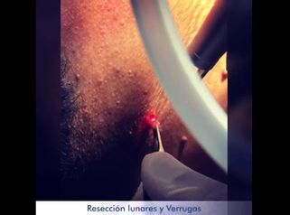 Eliminación de Lunares y Verrugas
