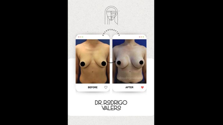 Aumento de busto - Dr. Rodrigo Valero Jarillo