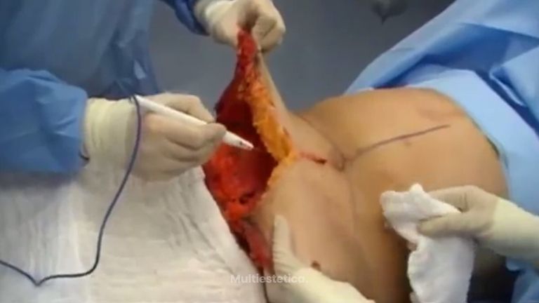 Así es una operación de abdominoplastia