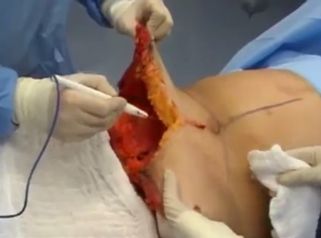 Así es una operación de abdominoplastia