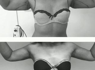 Braquioplastia - Dr. Alejandro Cruz Segura