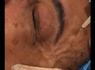 Carboxiterapia