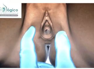 Rejuvenecimiento vaginal