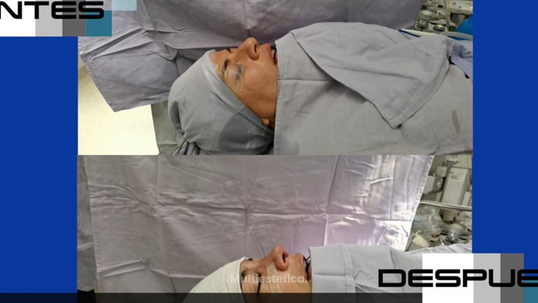 Rinoplastia - Dr. Lenin Alfonso Reyes Ibarra