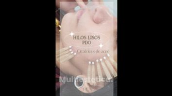 Hilos tensores - Clínica Heal Aesthetics