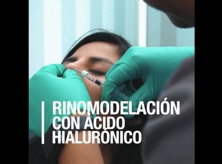 Rinomodelación con Ácido Hialurónico