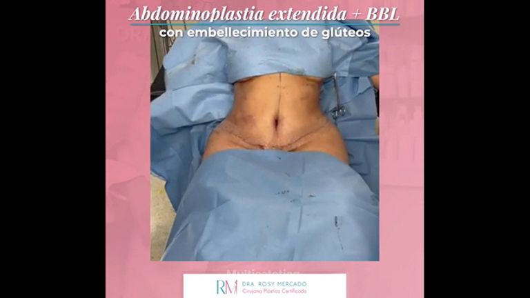 Abdominoplastia - Dra. Rosy Mercado