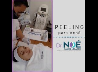 Peeling para acné - Dr. Rafael Noé Juarez Velasco