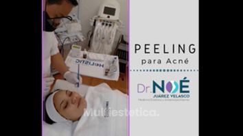 Peeling para acné - Dr. Rafael Noé Juarez Velasco