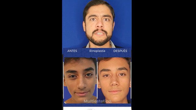 Rinoplastia - Dr. Gerardo Muñoz Jiménez