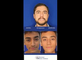 Rinoplastia - Dr. Gerardo Muñoz Jiménez