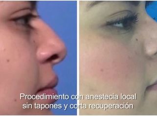 Rinoplastía estética