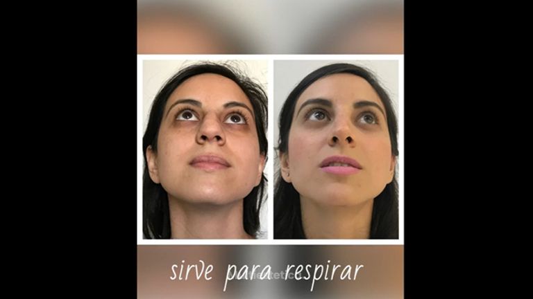 Rinoplastia - Dr. Christian Augusto Morales Orozco