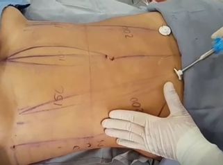 Alta definición Marcación abdominal