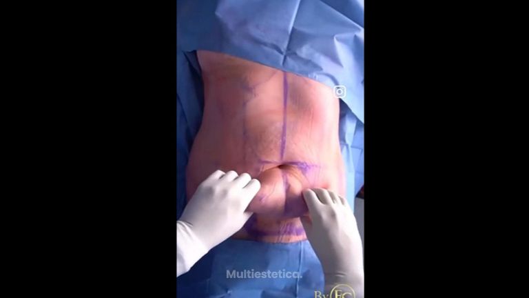 Abdominoplastia - Dr. Franco Cravioto