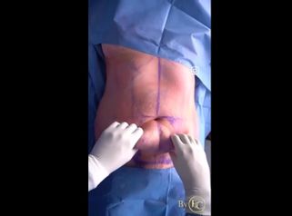 Abdominoplastia - Dr. Franco Cravioto