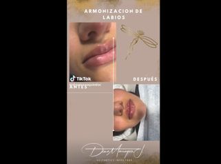 Aumento de labios - Joyas Clinique Spa