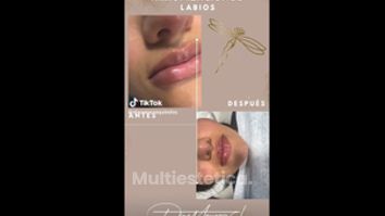 Aumento de labios - Joyas Clinique Spa