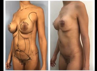 Aumento de busto y lipoescultura