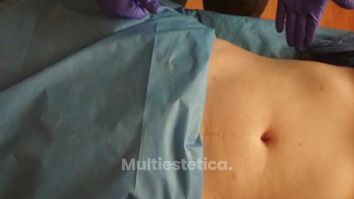 Cavitación